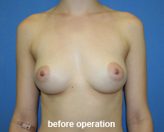 plastic-surgery-breast-augmentation